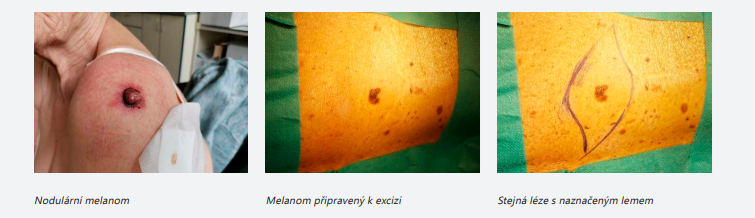 Druhy melanomů.png (227 KB)