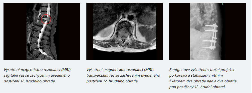 Nesnídal - tumory páteře.png (199 KB)