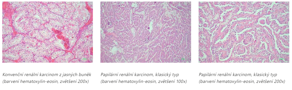 patologie karcinom.png (440 KB)