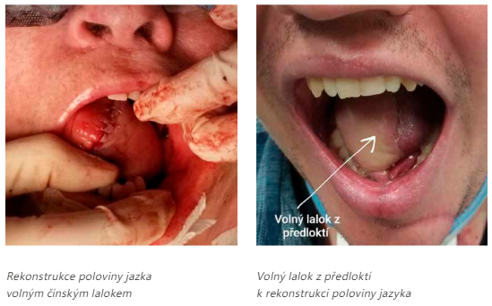 rekonstrukce jazyka lalokem copy 1.png (335 KB)
