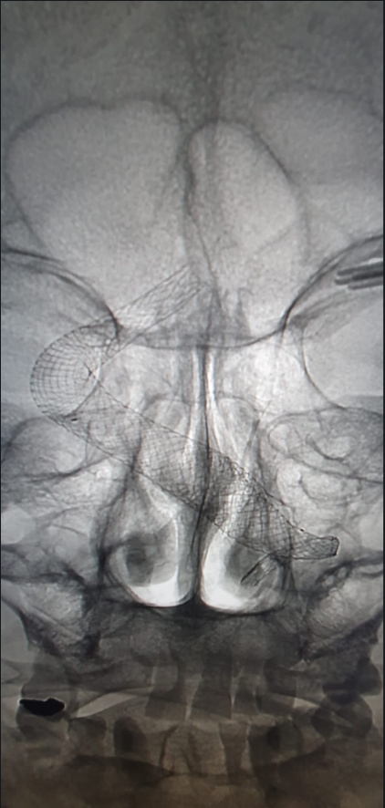 Uložený stent.png (578 KB)